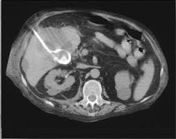 Διαδερμική (percutaneous) χολοκυστοστομία