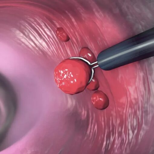 Πολύποδες παχέος εντέρου