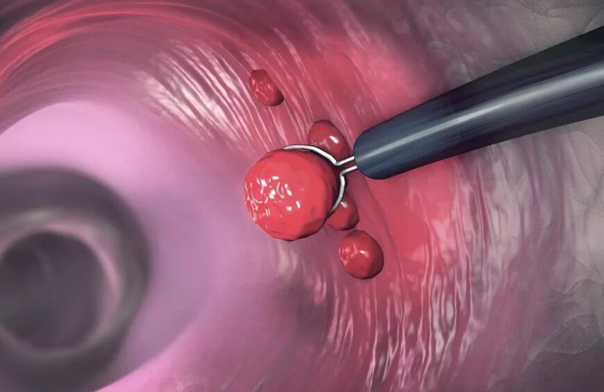 Πολύποδες παχέος εντέρου