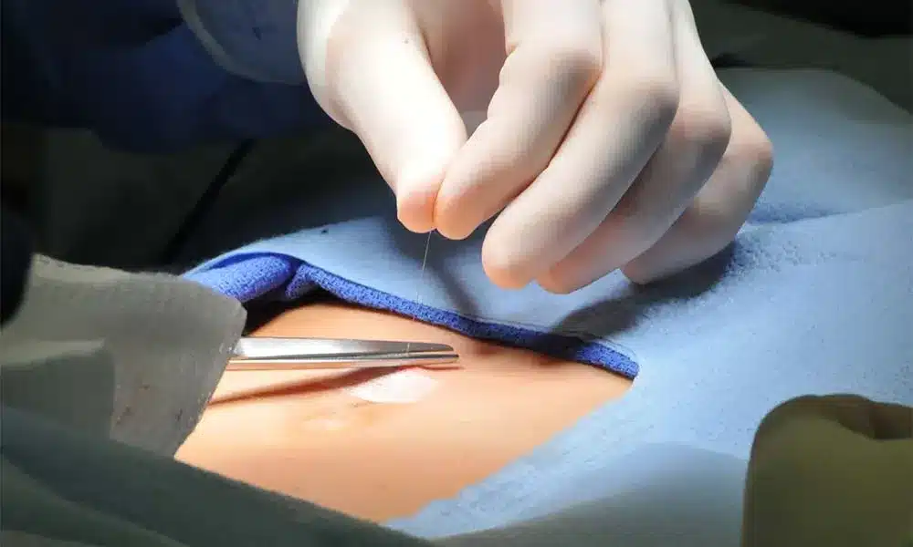 mesh problems Γεώργιος Σάμπαλης Προβλήματα και επιπλοκές πλεγμάτων