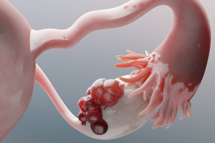 Κύστεις ωοθηκης