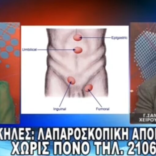 Λαπαροσκοπική Κήλη - Συνεντευξη στο Art Channel
