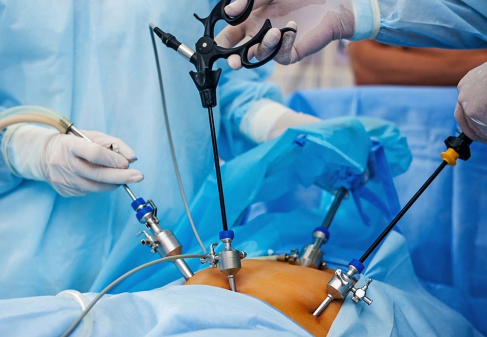 Λαπαροσκόπηση