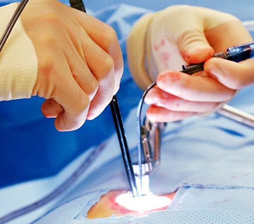 laser or laparoscopy
