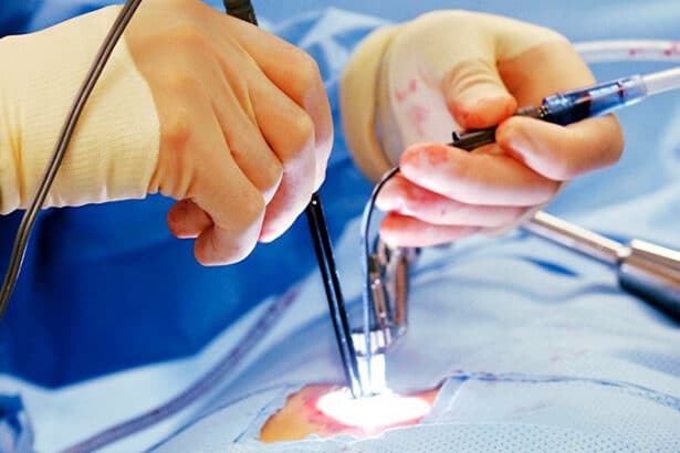 laser or laparoscopy