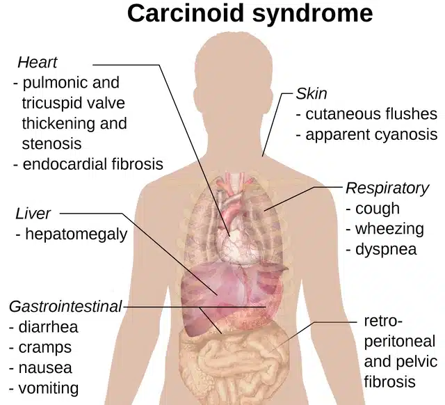 carcinoid syndrome Γεώργιος Σάμπαλης Καρκινοειδες συνδρομο