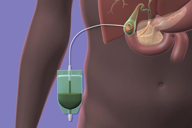 χολοκυστοστομια