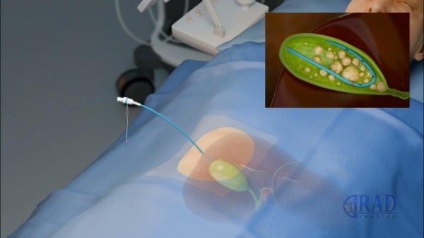 Τι είναι η χολοκυστοστομία;