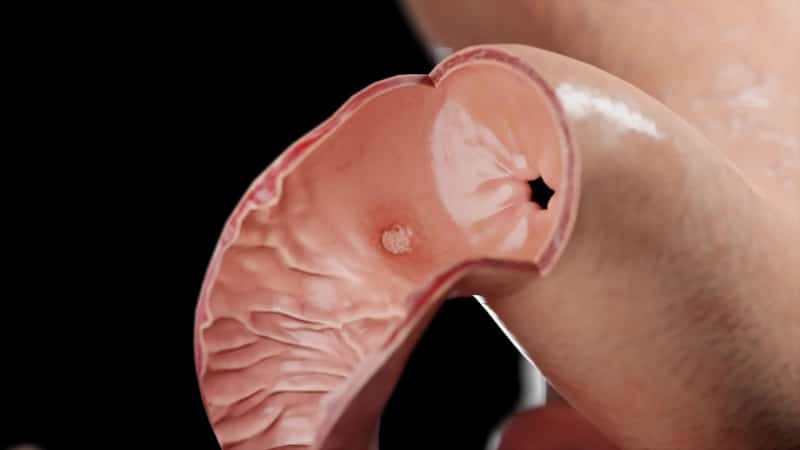 Έλκος στομάχου και 12δακτύλου