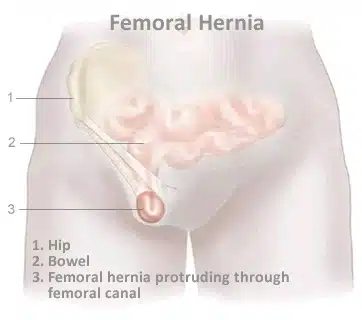 femoral Γεώργιος Σάμπαλης Μηροκήλη