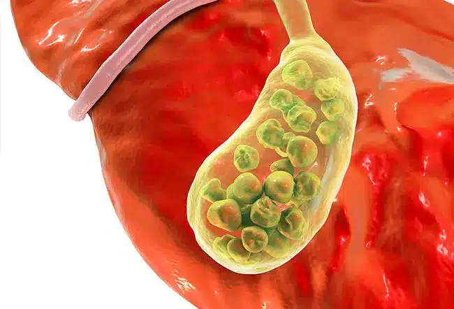 gallstonesgallbladderillustration Γεώργιος Σάμπαλης Χοληφόρος κολικός