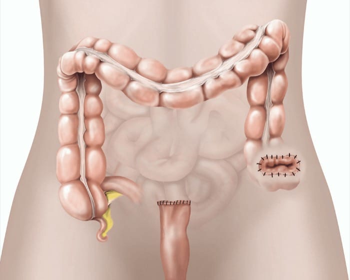 Σιγμοειδεκτομή Hartmann: πότε χρειάζεται