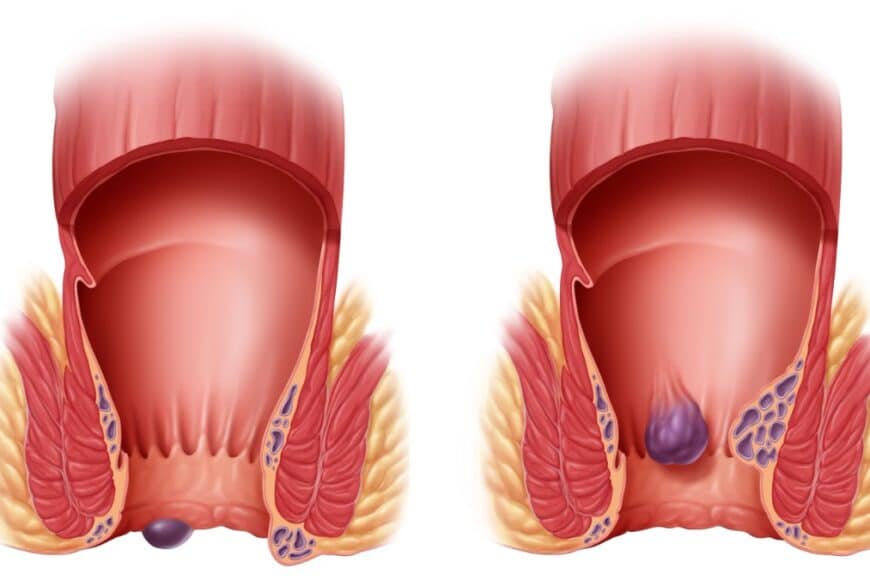 Θρόμβωση αιμορροϊδων