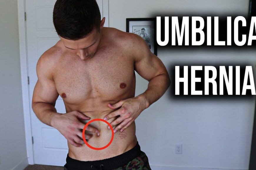 Ομφαλοκήλη και άσκηση