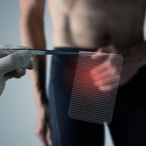 Υποτροπή Κήλης με πλέγμα