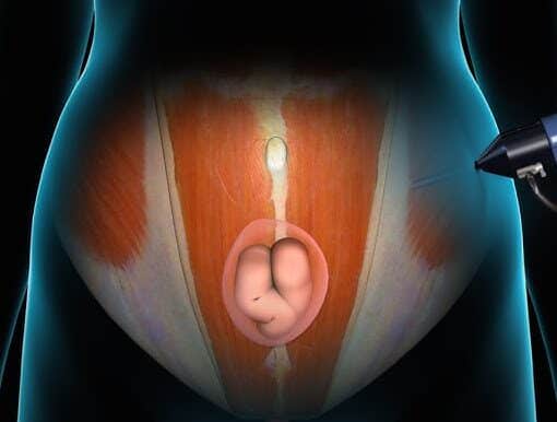 Λαπαροσκοπικη αποκατασταση κοιλιοκηλης