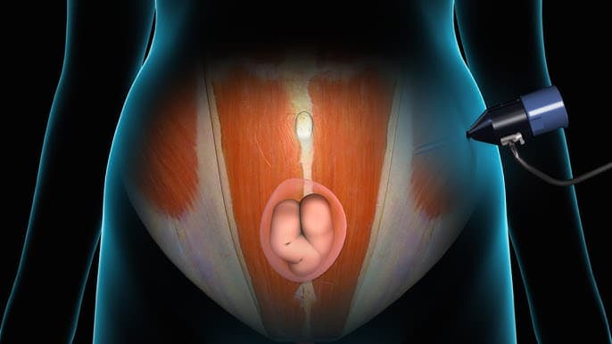 Λαπαροσκοπικη αποκατασταση κοιλιοκηλης