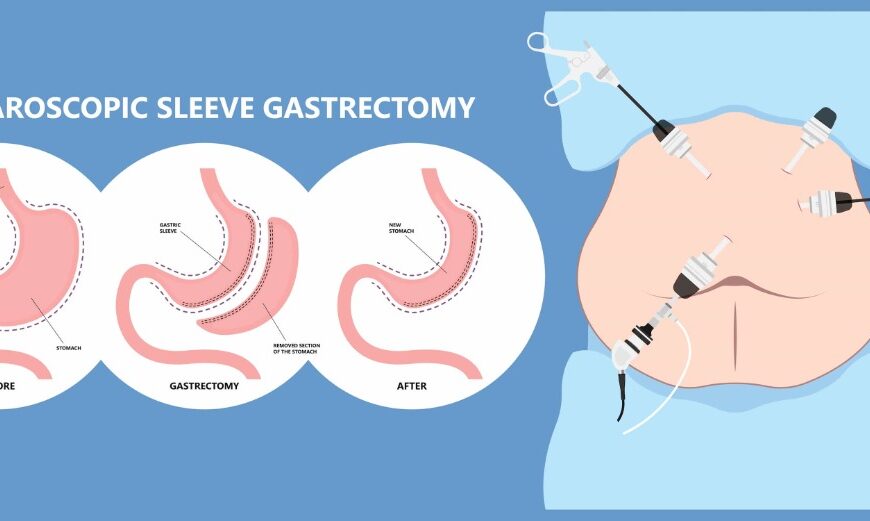 Sleeve gastrectomy