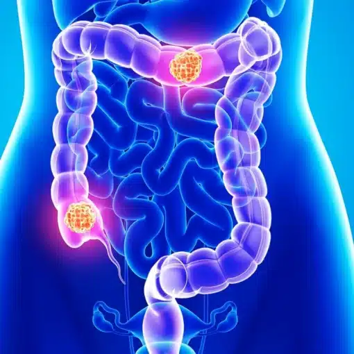 Δεξια κολεκτομη