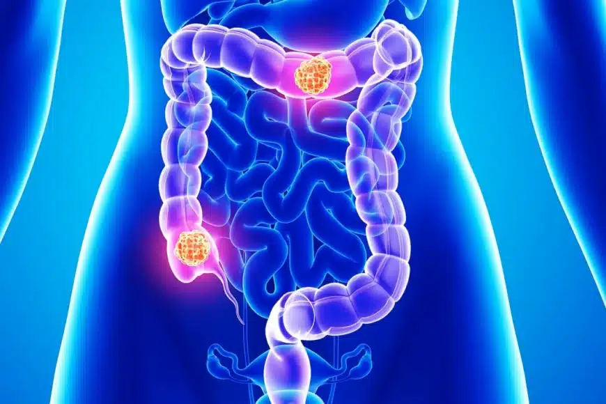 Δεξια κολεκτομη