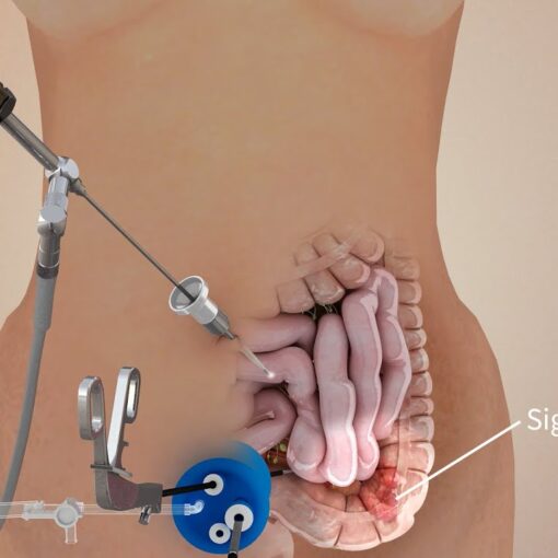 Σιγμοειδεκτομή