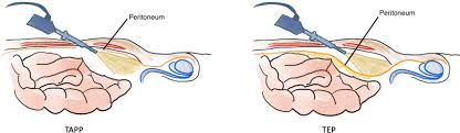 Λαπαροσκοπική TEP ή TAPP