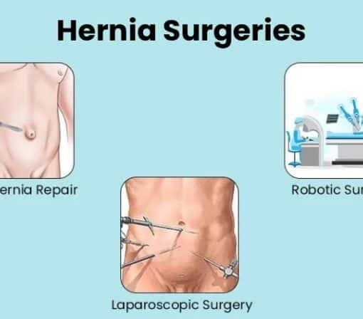 Ρομποτικη επεμβαση βουβωνοκηλης