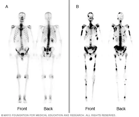 bone scan Γεώργιος Σάμπαλης Σπινθηρογράφημα οστών (Bone scan)