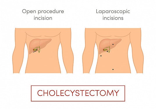 Τι πρέπει να προσέχω μετά από εγχείρηση χολής