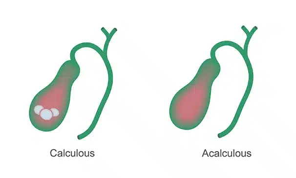 acutechloecystitis Γεώργιος Σάμπαλης Αλιθιασική χολοκυστίτιδα
