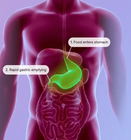 Dumping syndrome
