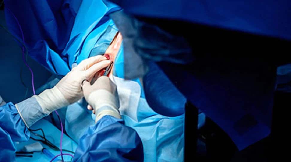 Έσω πλάγια σφιγκτηροτομή (LIS) για ραγάδα πρωκτού