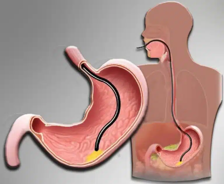 gastroskopi Γεώργιος Σάμπαλης Γαστροσκόπηση για διάγνωση ΓΟΠ