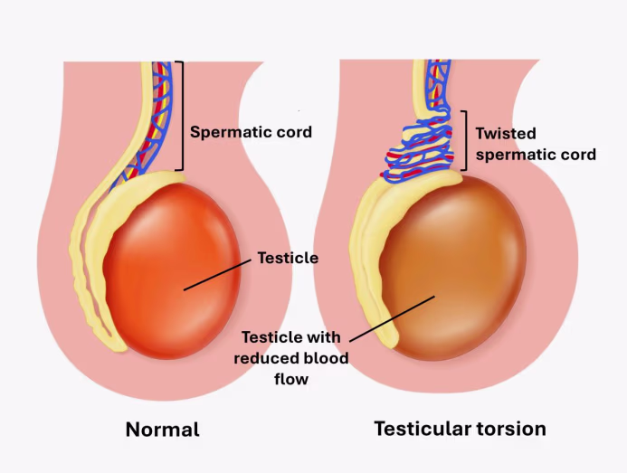 torsion Γεώργιος Σάμπαλης Συστροφή όρχεως