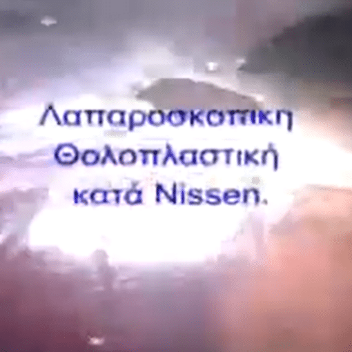 Λαπαροσκοπική αποκατάσταση Διαφραγματοκήλης