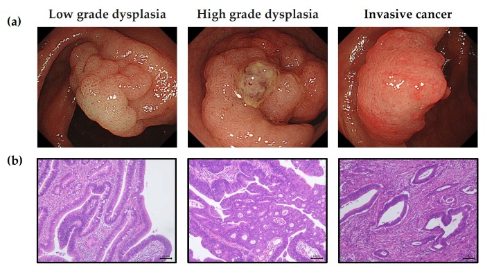 χαμηλόβαθμη από υψηλόβαθμη δυσπλασία παχέος εντέρου