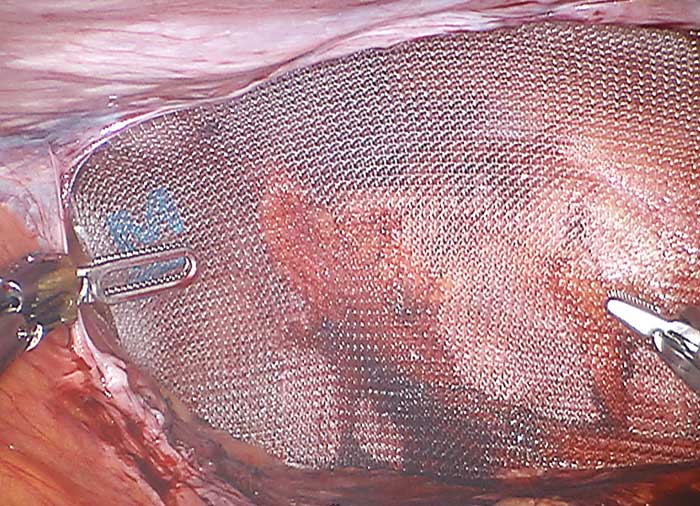 herniarepairwithmesh Γεώργιος Σάμπαλης Τοποθέτηση πλέγματος στην κοιλιοκηλη.