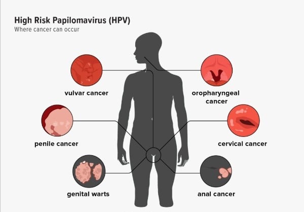HPV λοίμωξη: τι πρέπει να γνωρίζουν άνδρες και γυναίκες