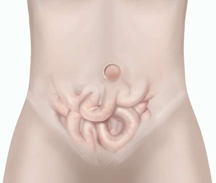 μικρή ομφαλοκήλη