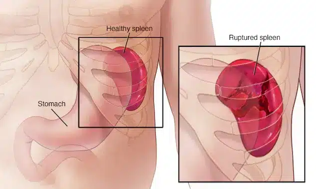 rupturedspleen Γεώργιος Σάμπαλης Τραύμα σπλήνα