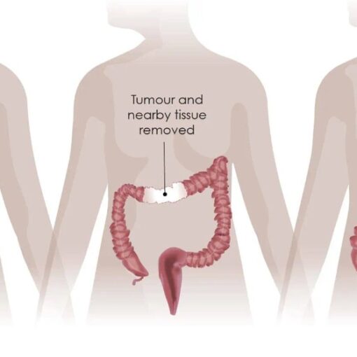 Three-panel diagram of colon cancer surgery: tumor in the colon, tissue around it removed, and the ends of the colon joined (anastomosis).
