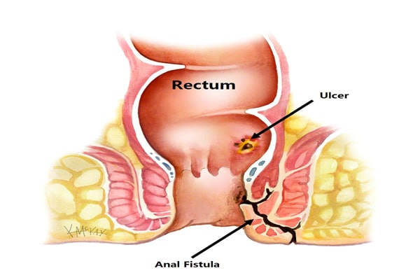 Cross-sectional illustration of the lower rectum showing an anal fistula and an adjacent ulcer on the anal canal.