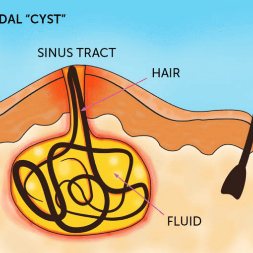 Cross-section diagram of a pilonidal cyst with a sinus tract, tangled hair, and fluid under the skin near the buttock.