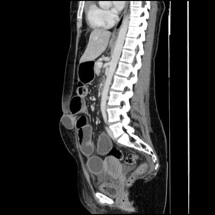 Sagittal CT image of the abdomen and spine showing lumbar vertebrae and surrounding soft tissues with gas-filled bowel loops.