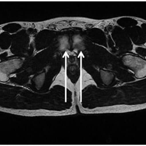 Κήλη των αθλητών και μαγνητική τομογραφία