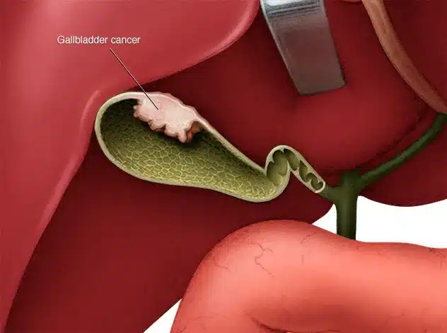 gallbladdercancer Γεώργιος Σάμπαλης καρκίνος χοληδόχου κύστης