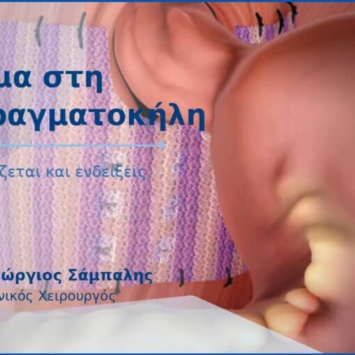 Πλέγμα στη διαφραγματοκήλη