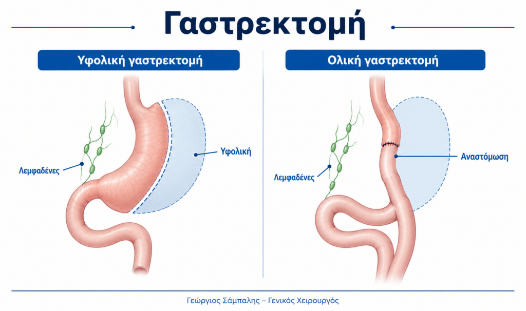 Γαστρεκτομή με υφολική και ολική αφαίρεση στομάχου για καρκίνο στομάχου