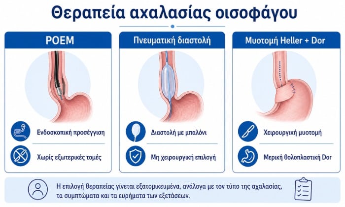 Θεραπεία αχαλασίας οισοφάγου με POEM, πνευματική διαστολή και μυοτομή Heller