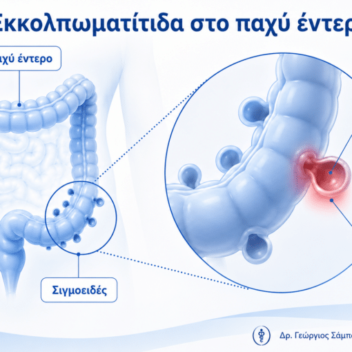 Εκκολπωματίτιδα στο σιγμοειδές τμήμα του παχέος εντέρου με φλεγμονή εκκολπώματος
